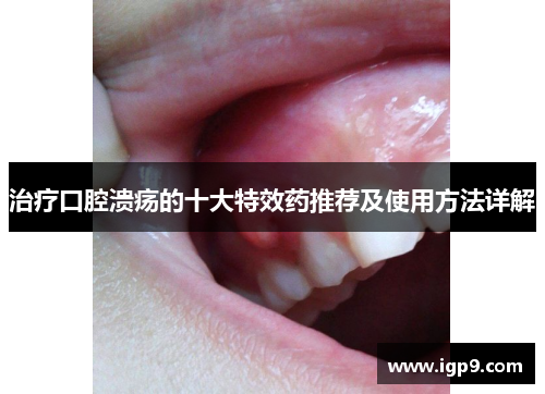 治疗口腔溃疡的十大特效药推荐及使用方法详解